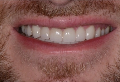 Close-up of male smile displaying white teeth and dental work results