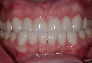 Close-up of healthy white teeth and pink gums in dental office setting.