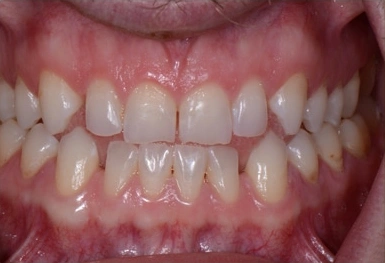 Close-up view of upper and lower teeth showing dental alignment and tooth structure in clinical setting.