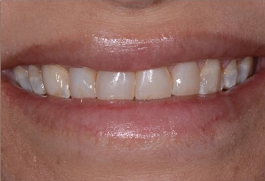 Close-up of smile showing upper teeth with white dental veneers or crowns against pink gums.