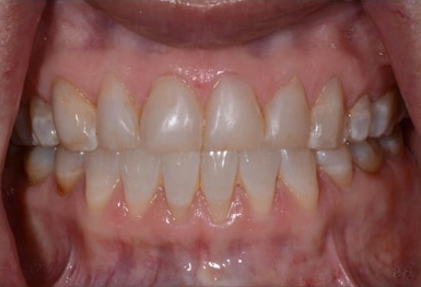 Close-up view of upper and lower teeth showing dental alignment and oral health condition.