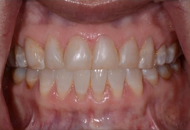 Close-up of front teeth showing upper and lower dental alignment and tooth structure.