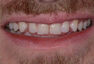 Close-up of male smile showing teeth with visible gaps and discoloration requiring dental treatment.