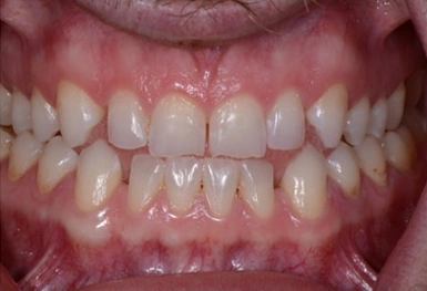 Close-up dental photograph showing upper and lower teeth with visible discoloration and alignment issues.