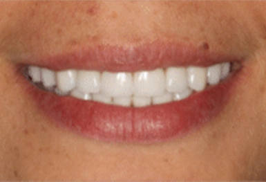 Close-up of person's smile showing white teeth and natural lip color against skin tone.