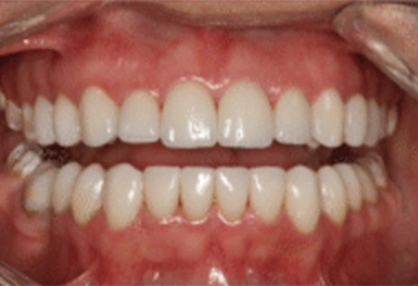 Close-up view of a patient's smile showing upper and lower teeth with healthy gums and natural tooth alignment.