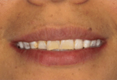 Close-up of a person's smile showing teeth and lips in natural lighting.