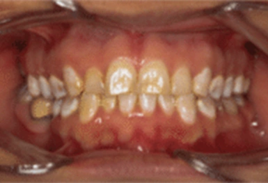 Close-up intraoral view of upper and lower teeth showing dental occlusion and tooth alignment.
