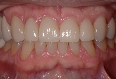 Close-up view of upper and lower teeth showing dental alignment and gum health in clinical setting.