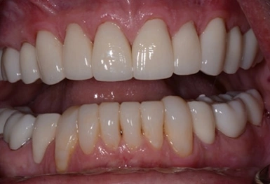 Close-up of upper and lower teeth showing dental crowns and restorations in a clinical setting.