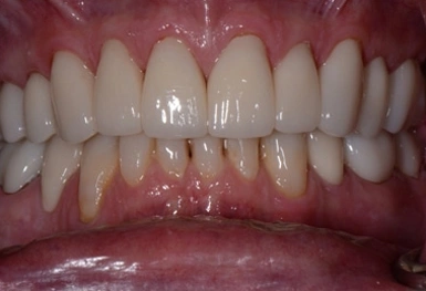 Close-up of healthy white teeth and gums in dental office setting during examination.
