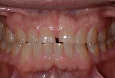 Close-up view of upper and lower teeth showing dental alignment and gum health in clinical setting.