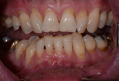 Close-up of human teeth and gums showing dental condition and bite alignment in clinical setting.