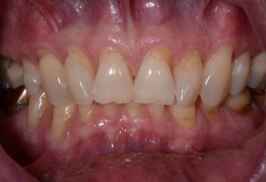 Close-up view of upper and lower teeth showing dental work and gum condition in clinical setting.