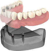 Dental implant bridge model showing prosthetic teeth attached to jawbone structure.