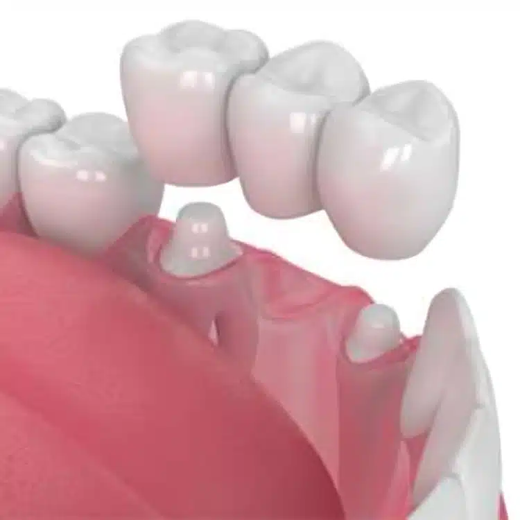 Dental crown placement illustration showing ceramic crowns positioned on tooth model with gum tissue.