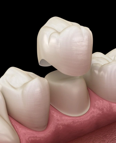 Dental crowns displayed on gum model showing tooth restoration and replacement procedure.