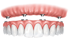 Dental implant crown restoration showing gum tissue and multiple tooth replacements in anatomical cross-section.