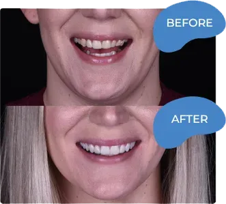 Before and after dental comparison showing improved smile brightness and tooth whiteness results.