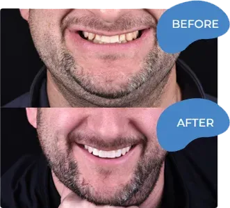 Before and after dental treatment comparison showing improved smile and teeth whiteness.