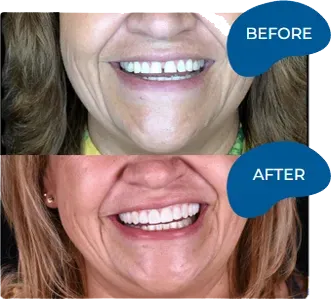 Before and after smile transformation showing improved teeth whiteness and brightness from dental treatment.