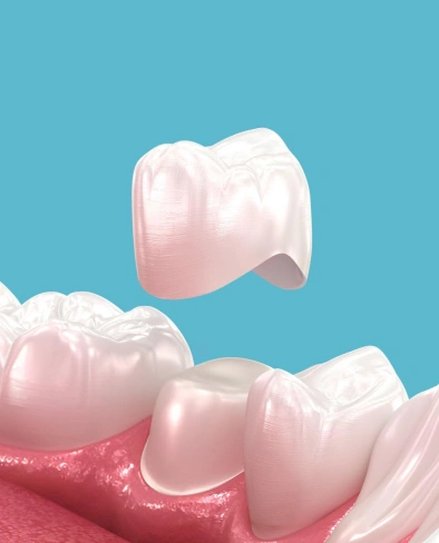 Dental crown being placed on tooth model against blue background, demonstrating restorative dentistry procedure.