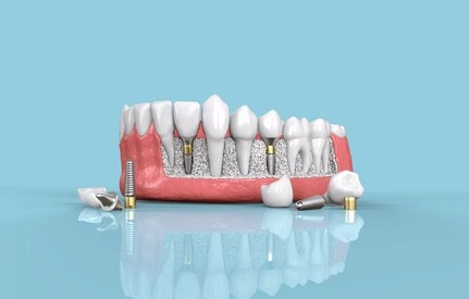 Dental implant model displaying crowns and implants on blue background for educational purposes.