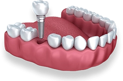 Dental implant model showing tooth replacement procedure on pink gum structure with implant post.